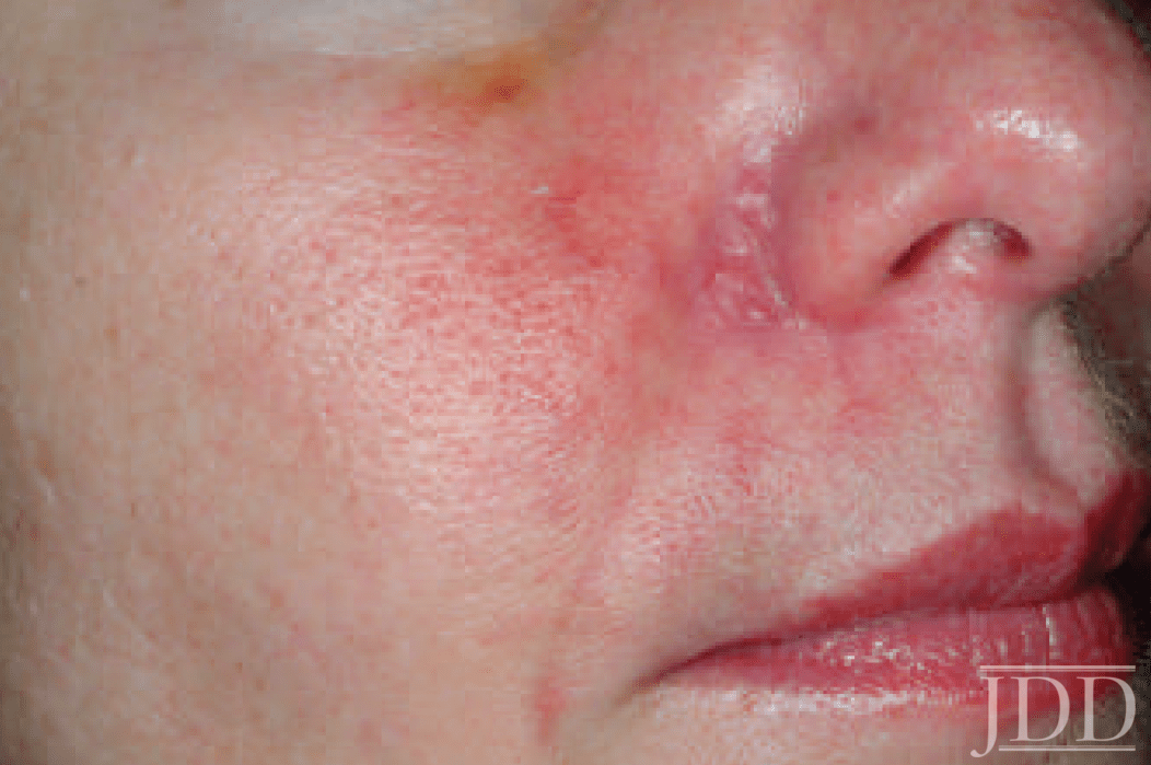 Vascular Complications of Fillers Treatment Pearls for Impending