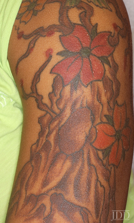 Eruptive Milia Within A Tattoo - Next Steps In Dermatology 741_x_446_jpg
