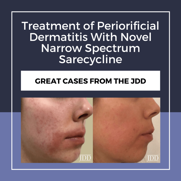 Treatment of Periorificial Dermatitis With Novel Narrow Spectrum
