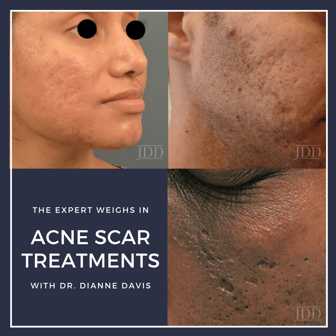 Acne Scar Treatments The Expert Weighs In Next Steps in Dermatology