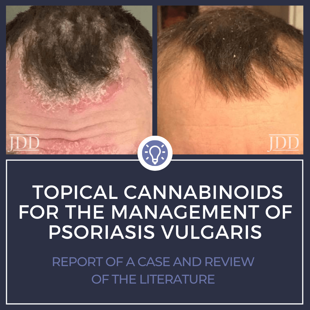 Triamcinolone Acetonide Cream Uses