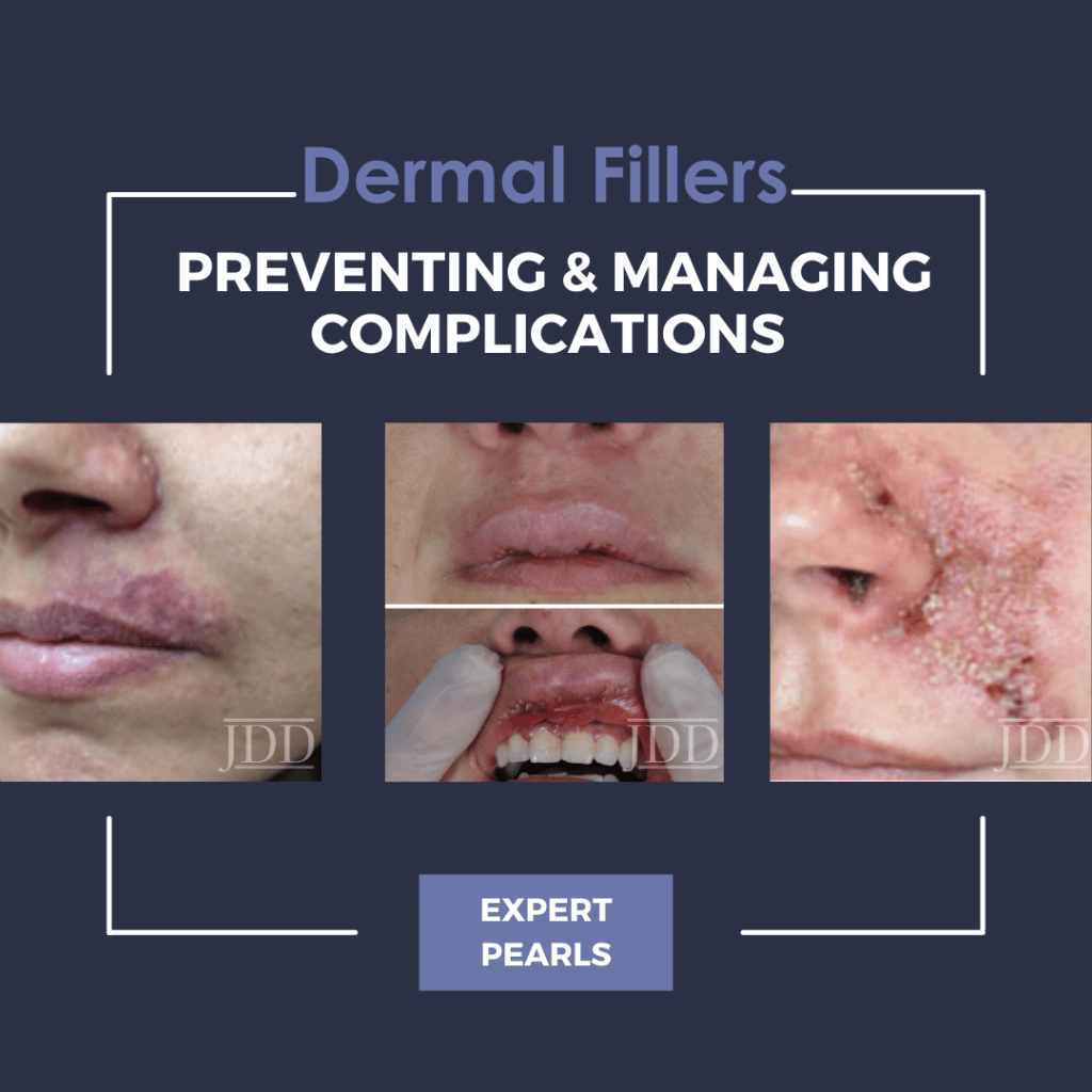 Dermal Filler Injections Preventing & Managing Complications Pearls