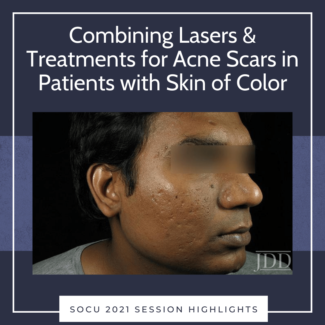 Combining Lasers & Treatments for Acne Scars in Patients with Skin of