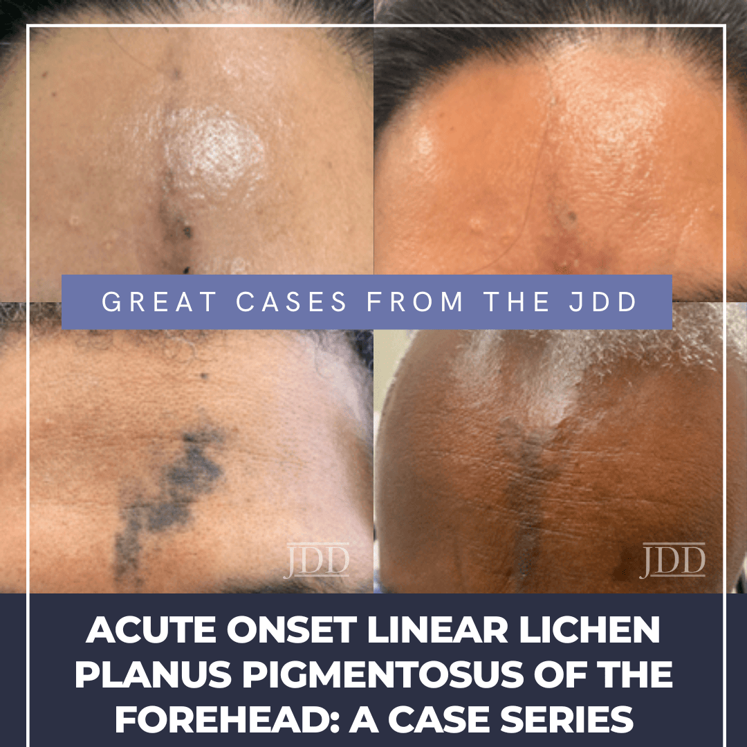 Acute Onset Linear Lichen Planus Pigmentosus of the Forehead A Case Series Next Steps in