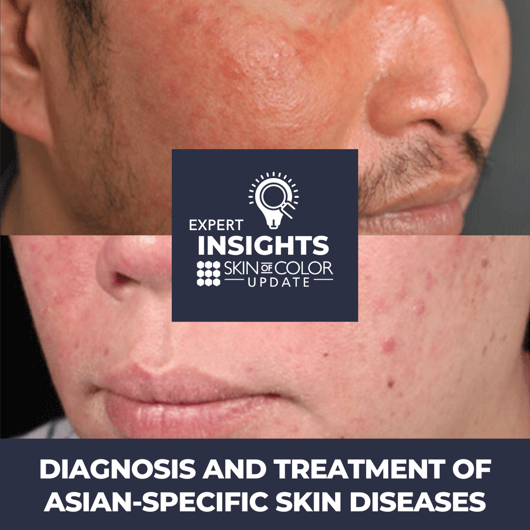 Diagnosis and Treatment of AsianSpecific Skin Diseases Next Steps in