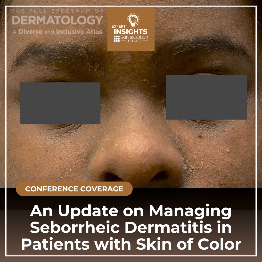 managing seborrheic dermatitis SOC Archives Next Steps in Dermatology