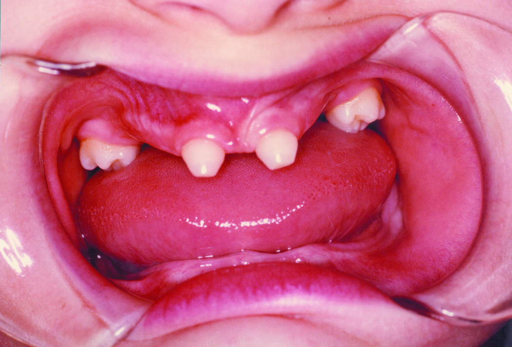 Dental Symptoms Ectodermal Dysplasia NFED