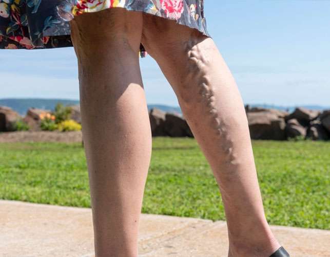 Varicose Veins Treatment NG Vascular & Vein Center