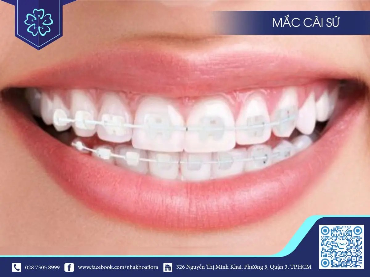 WHAT CAUSES TEETH TO GROW OUT? HOW TO CHOOSE THE RIGHT BRACES METHOD