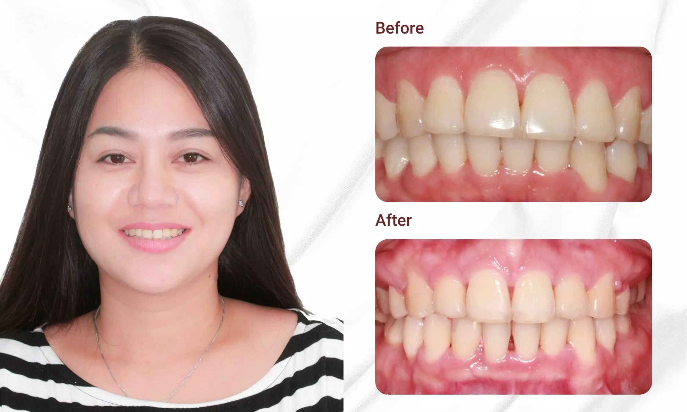 What Is Orthodontic? Price List, Procedure, And Important Considerations