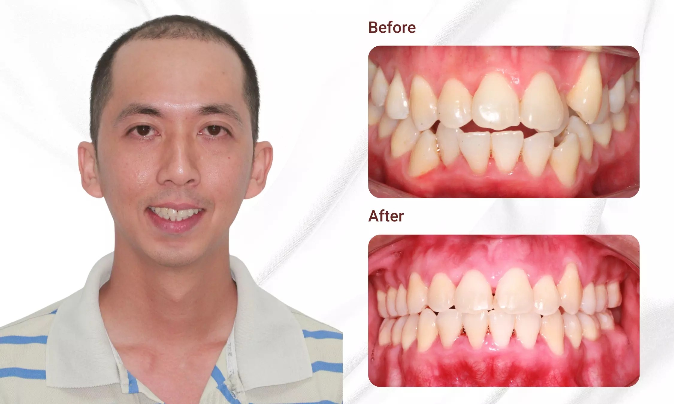 What Is Orthodontic? Price List, Procedure, And Important Considerations