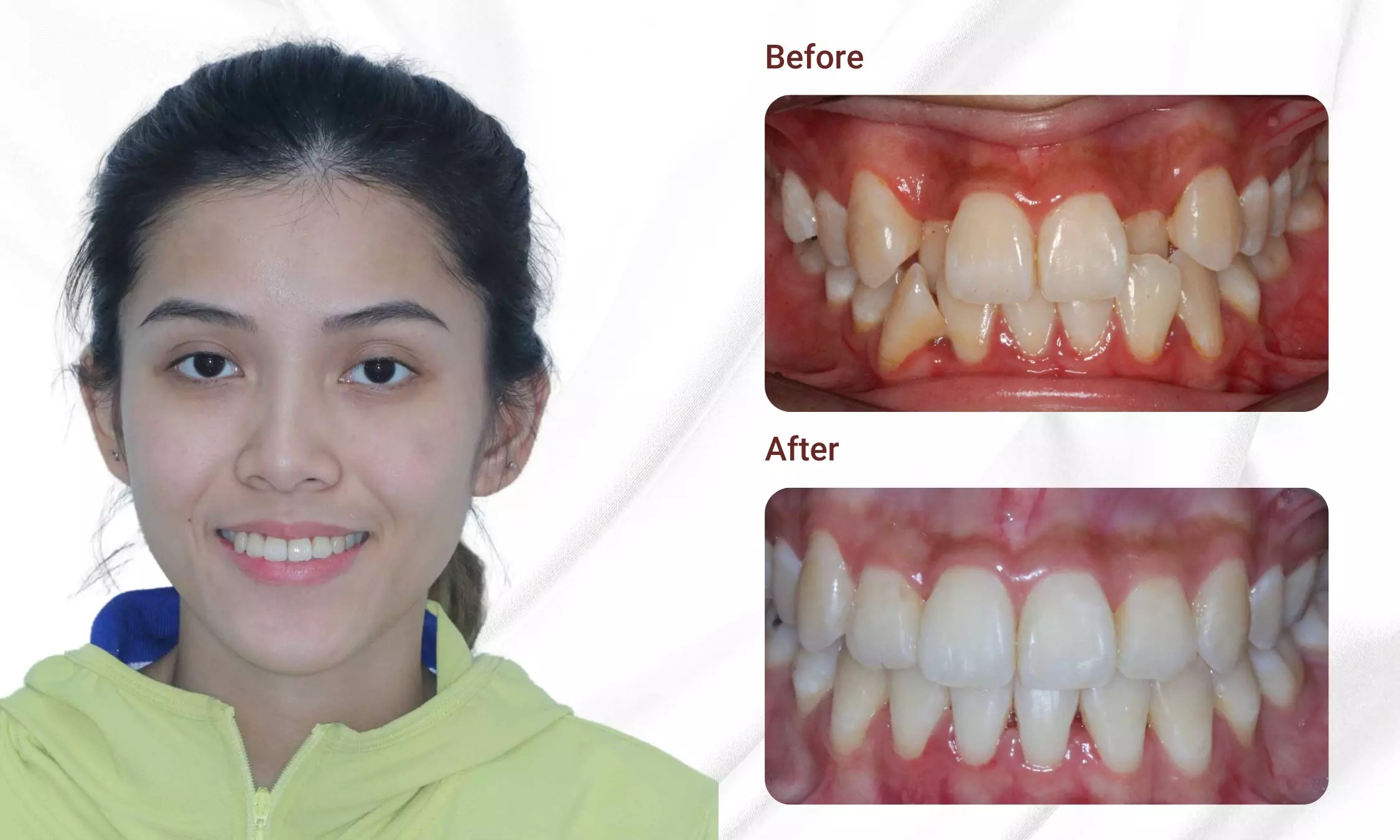 What Is Orthodontic? Price List, Procedure, And Important Considerations