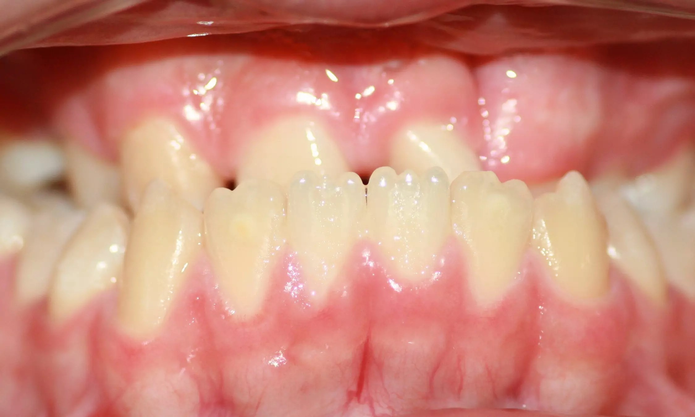 What Is Orthodontic? Price List, Procedure, And Important Considerations