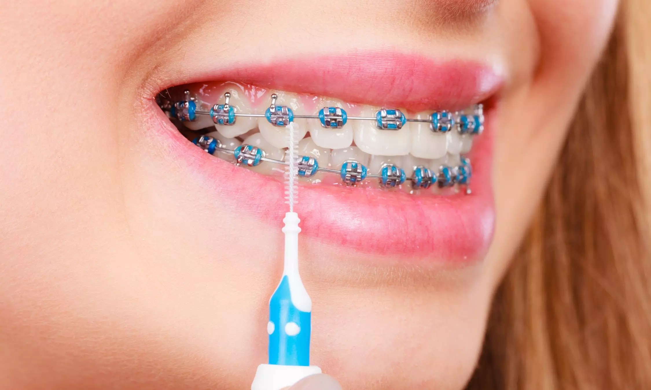 What Is Orthodontic? Price List, Procedure, And Important Considerations