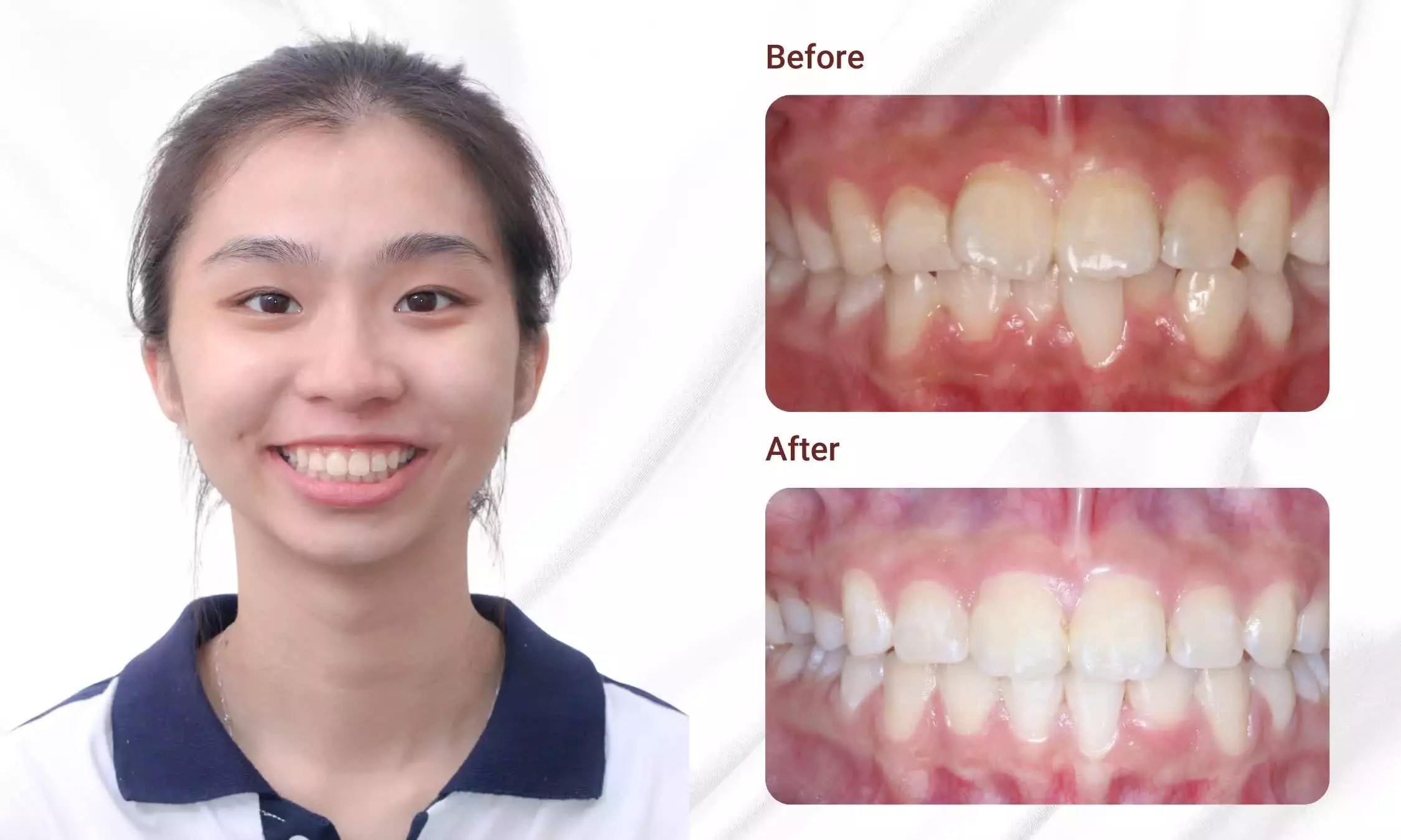 What Is Orthodontic? Price List, Procedure, And Important Considerations