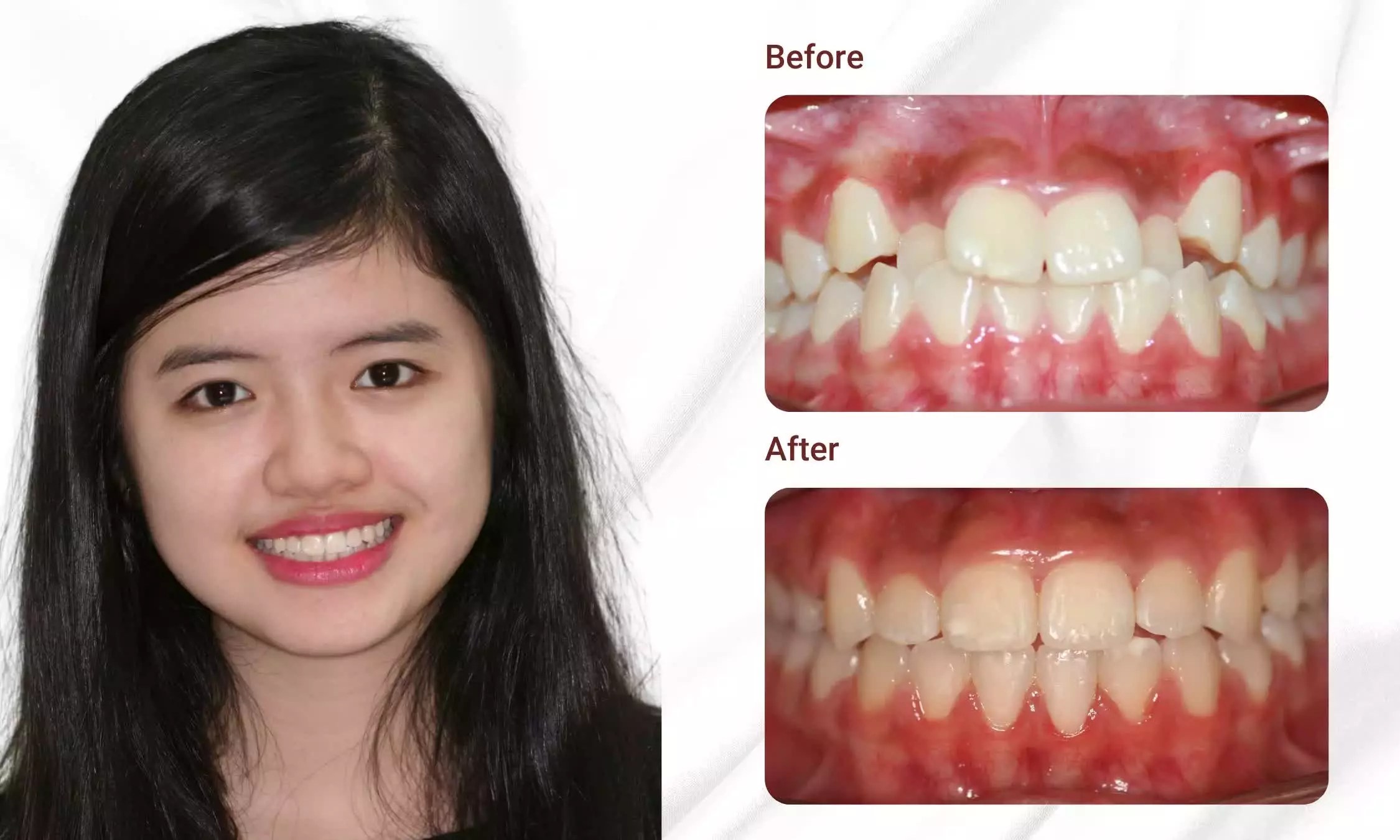What Is Orthodontic? Price List, Procedure, And Important Considerations