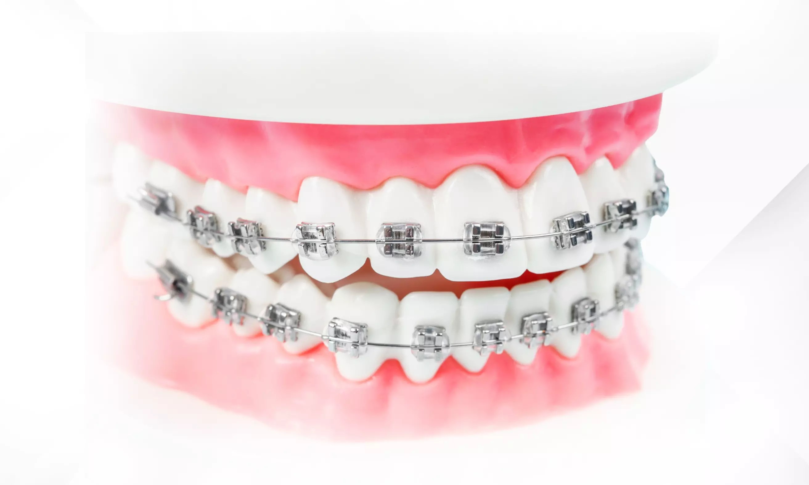 What Is Orthodontic? Price List, Procedure, And Important Considerations