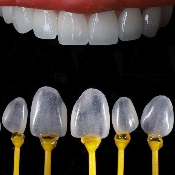 Dán Sứ Veneer Emax Có Tốt Không? Giải Đáp Cùng Nha Sĩ