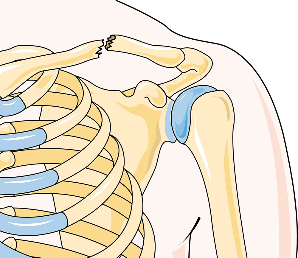 NHS Forth Valley Child Clavicle Fracture