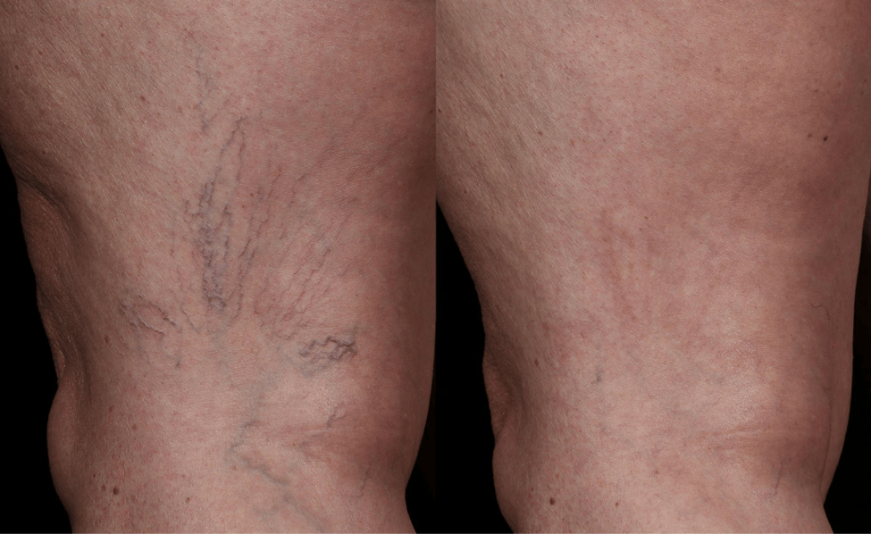 Laser Thread Vein Removal London Laser Vein Removal Near Me