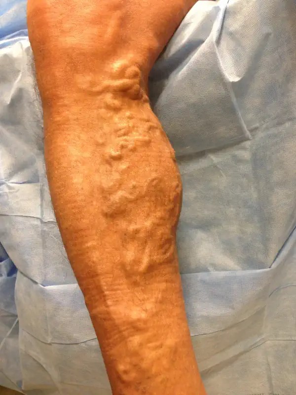 Venous Insufficiency Symptoms, Diagnosis and Treatments