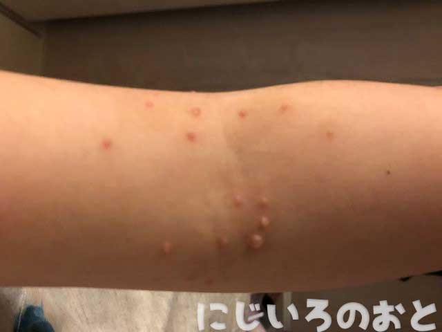 蒸留木酢液 水イボ けんきの滴 | 水イボ木酢液けんきの滴 子どもの水イボがなかなか治らない時のおすすめ対処法！皮膚科？木酢