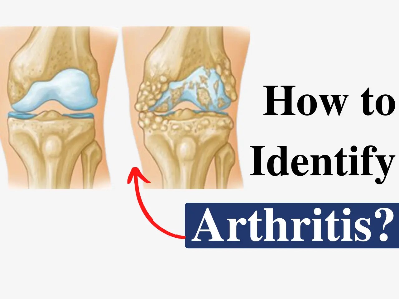 How to Identify Arthritis? Arthritis Symptoms, Causes & Treatment