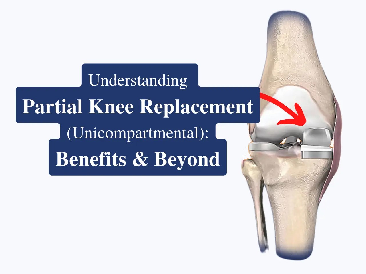 What is Partial Knee Replacement
