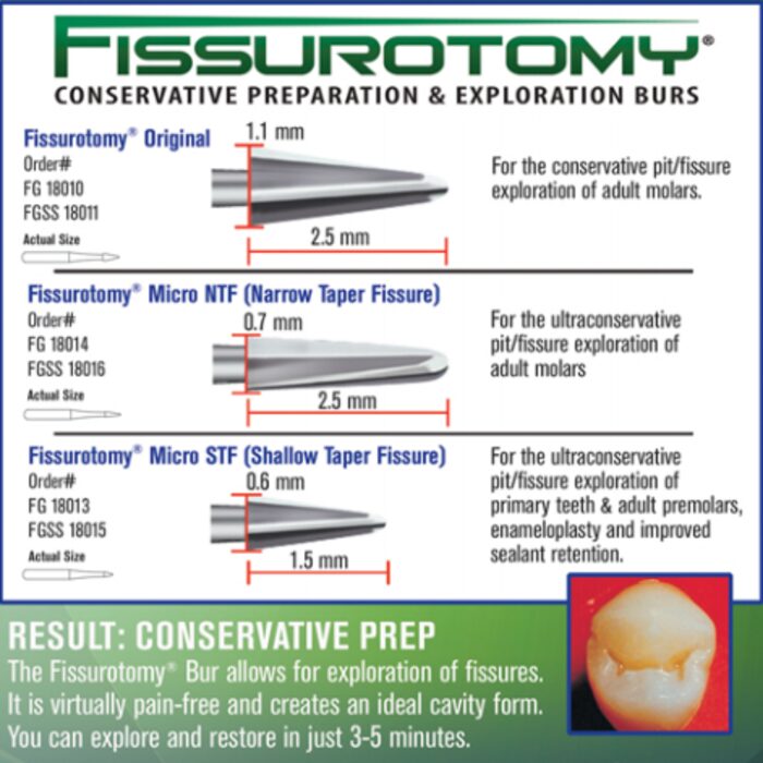 Fissurotomy® Nile Dental