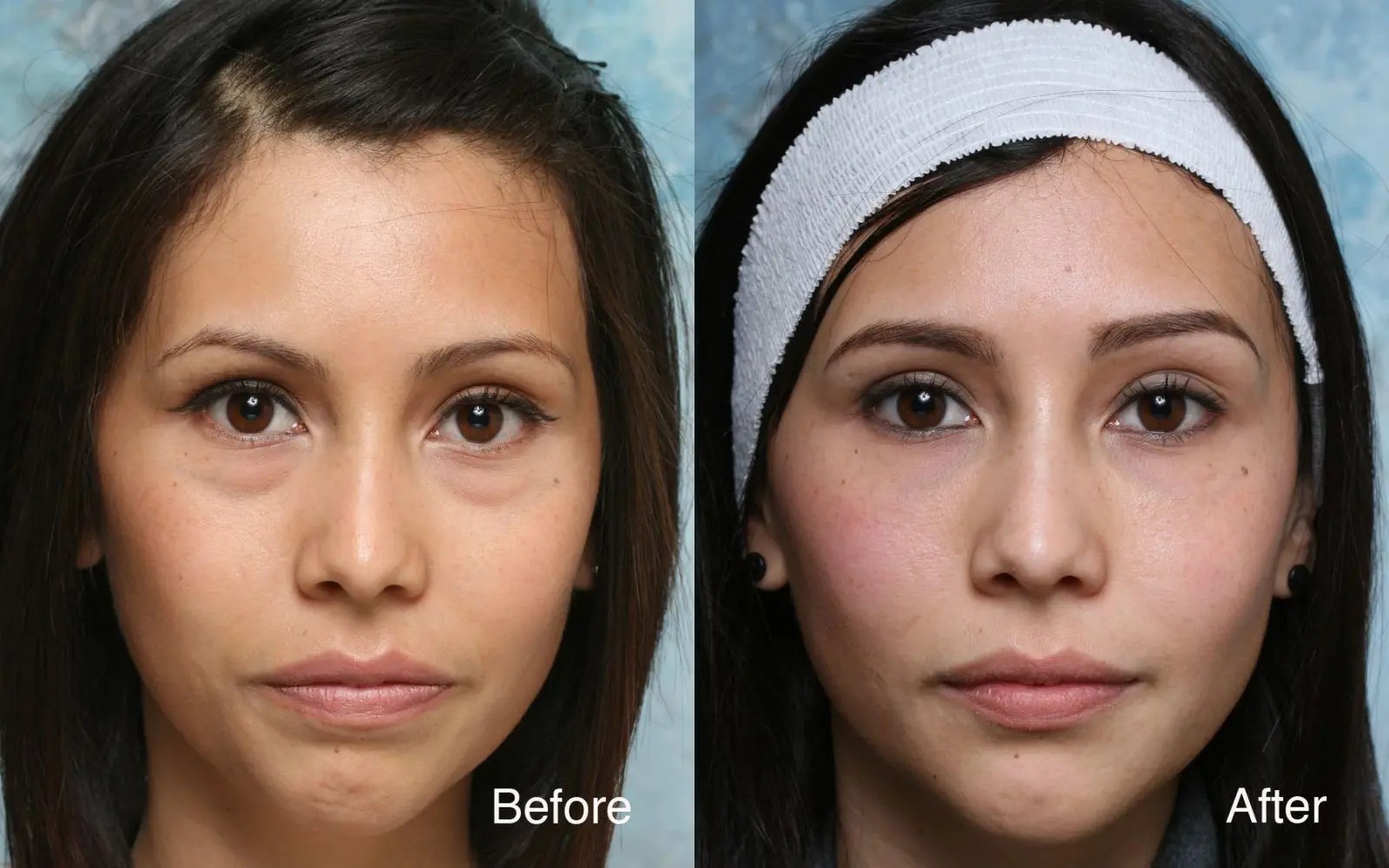 Eye Bag Removal Surgery In Singapore ⋆