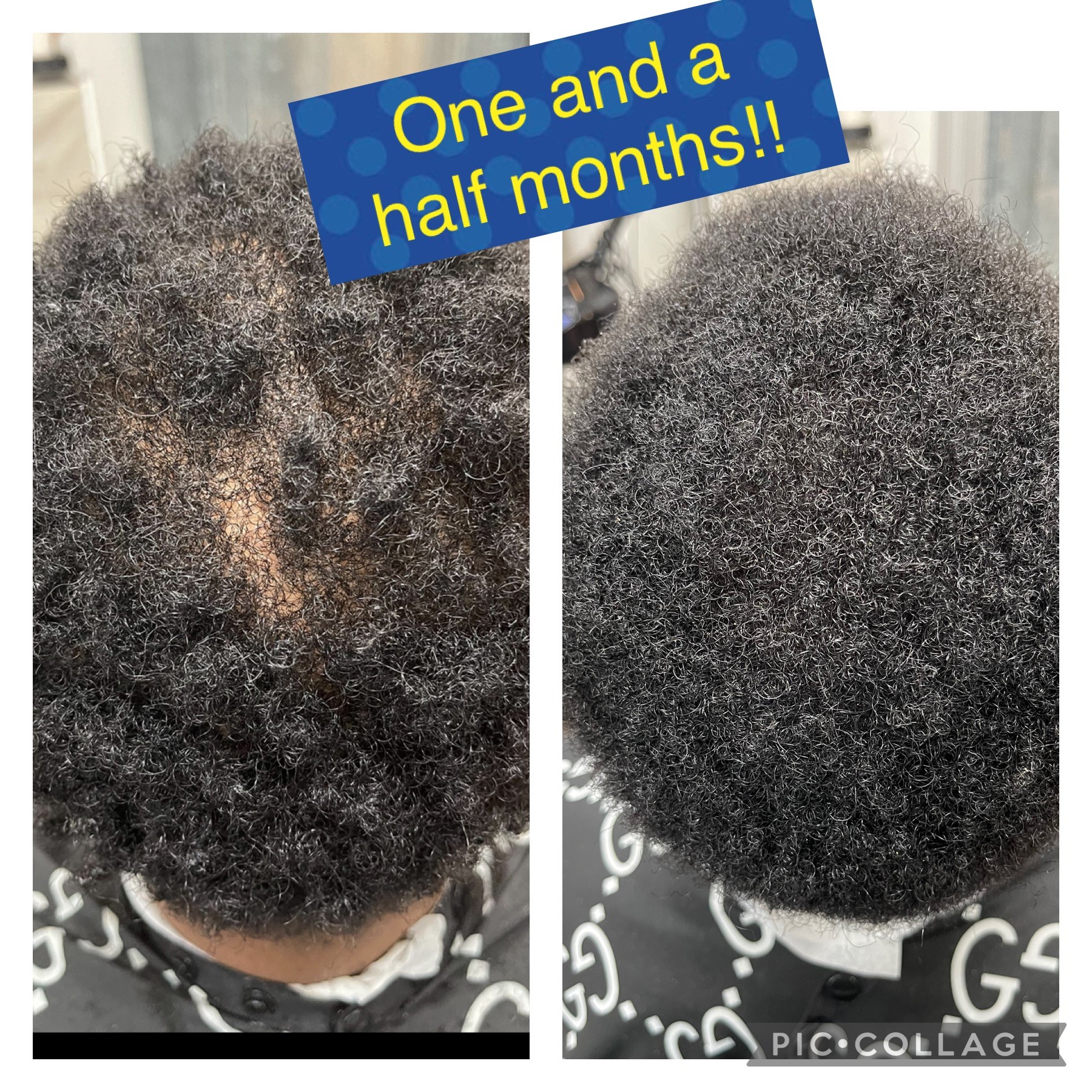 Hair Restoration Houston TX Hair Loss Treatment Houston Hair Loss