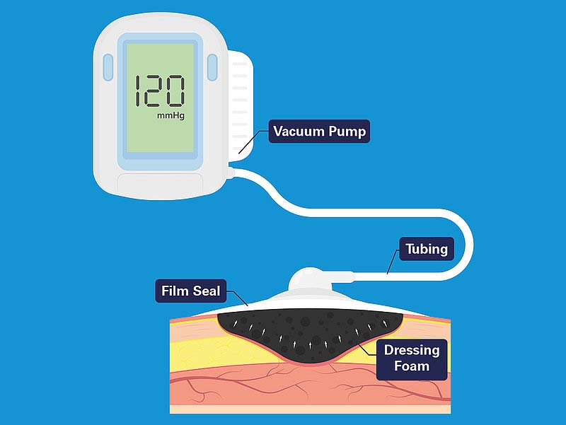 NJPRO vacuum pump applied in Negative Pressure Wound Therapy (NPWT) NJPRO Manufacturer of