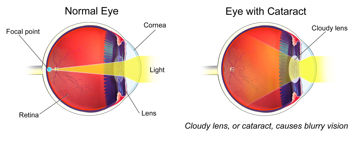 Cataract Surgery & Keratoconus