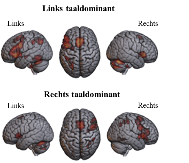 Het Bijzondere Brein Van Linkshandigen | In-Mind