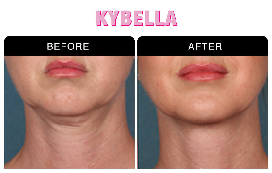 Discounted Medical Kybella Treatment at National Laser
