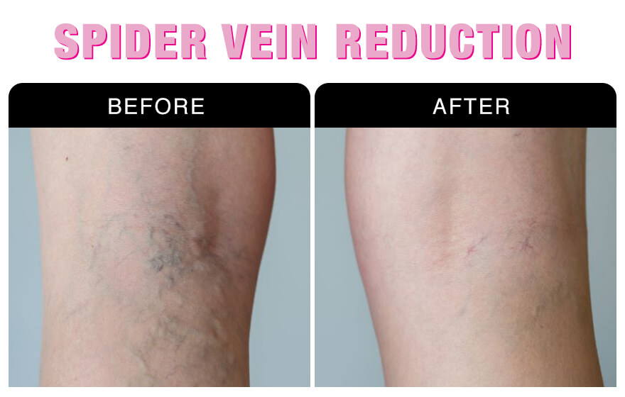 Spider Vein Removal Treatment National Laser Institute Medical Spa