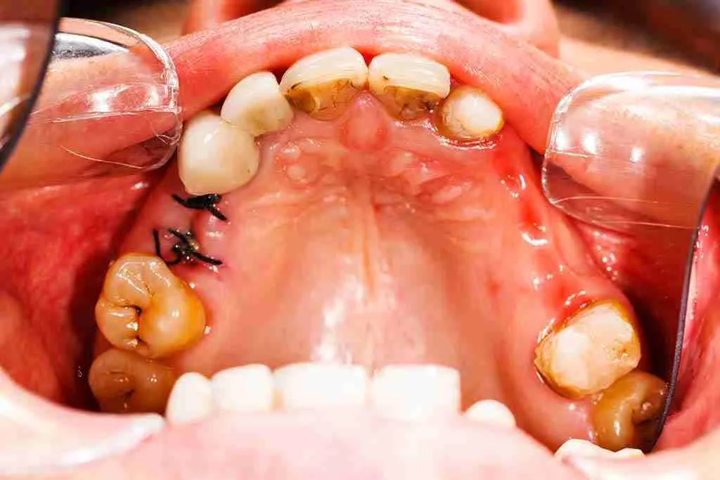 Extraction dentaire, soins dentaires à Koekelberg Bruxelles