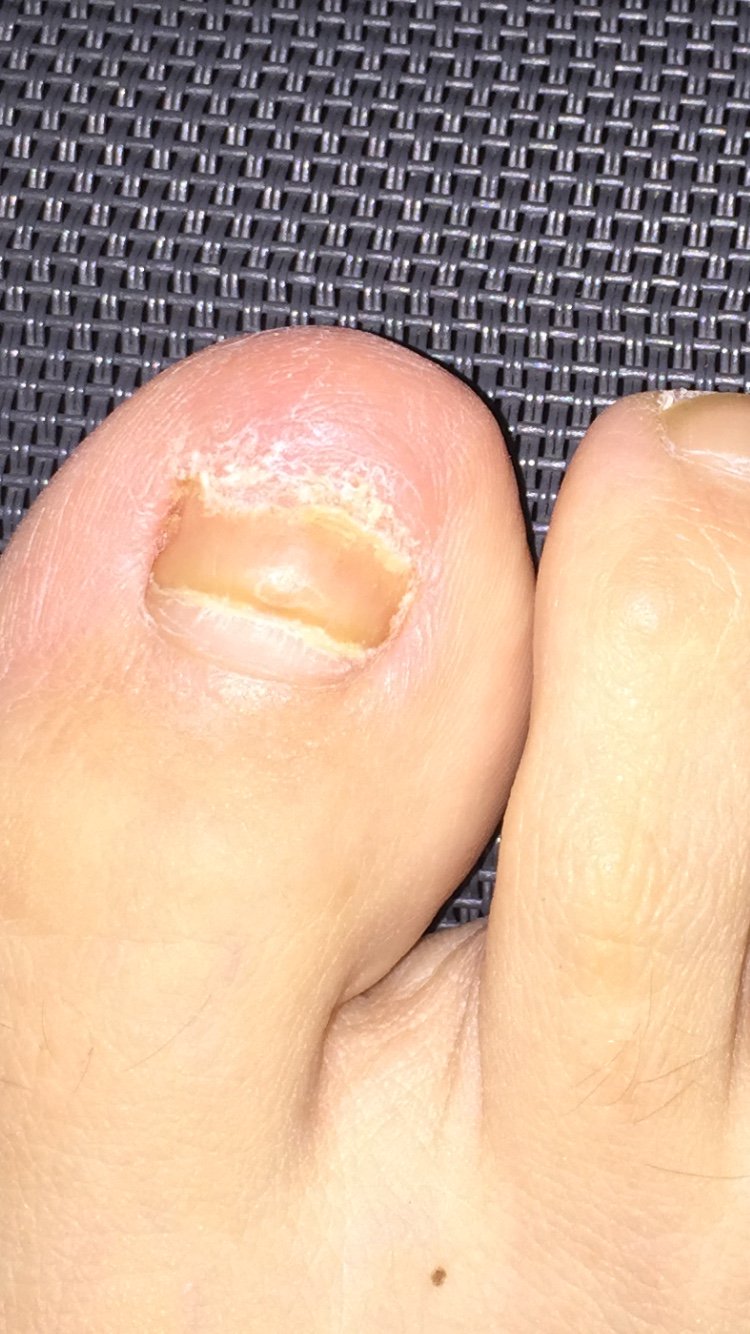 My toenail fell off (sorry for the pic) need help