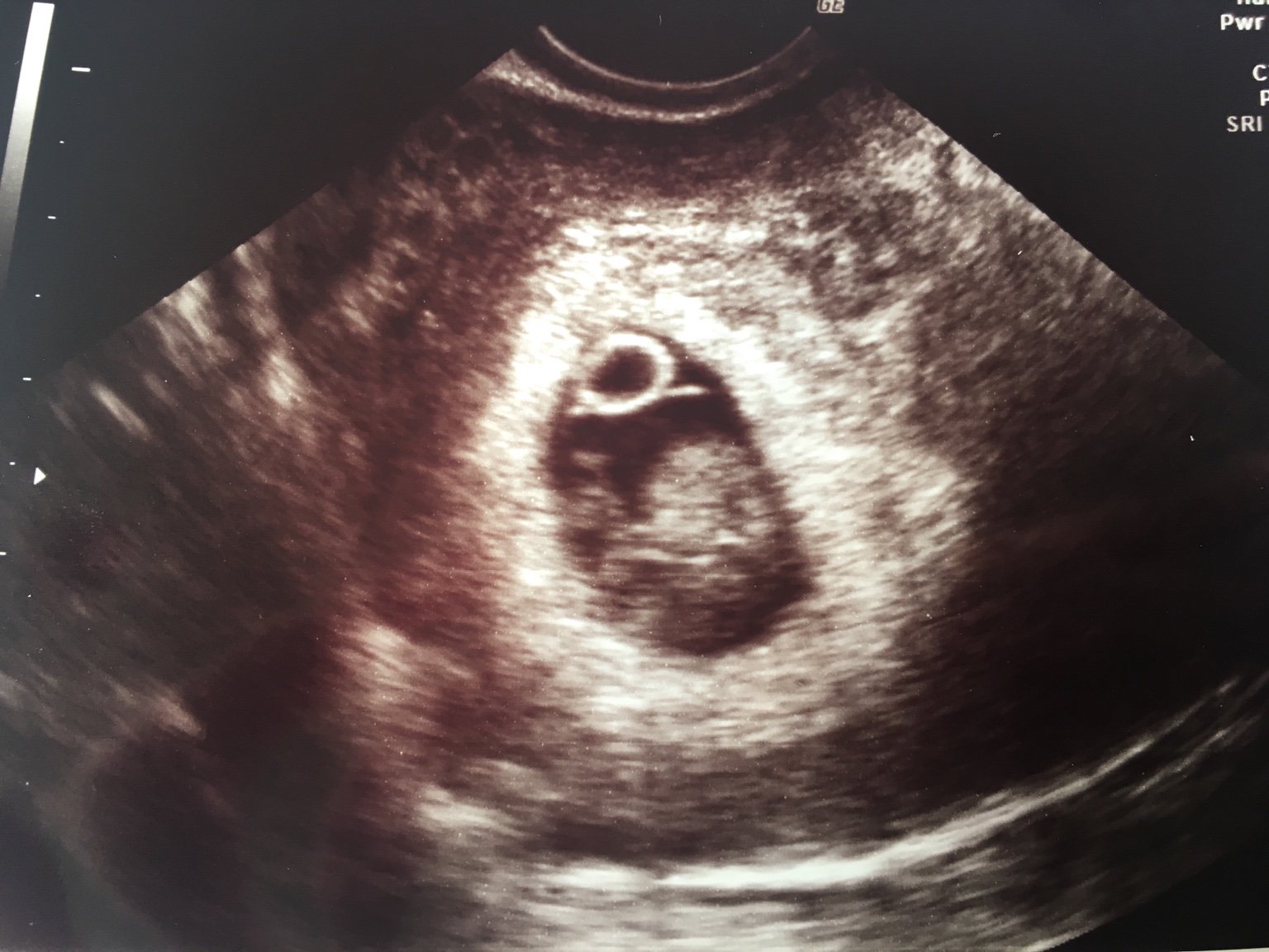 Reassurance scan 8 weeks
