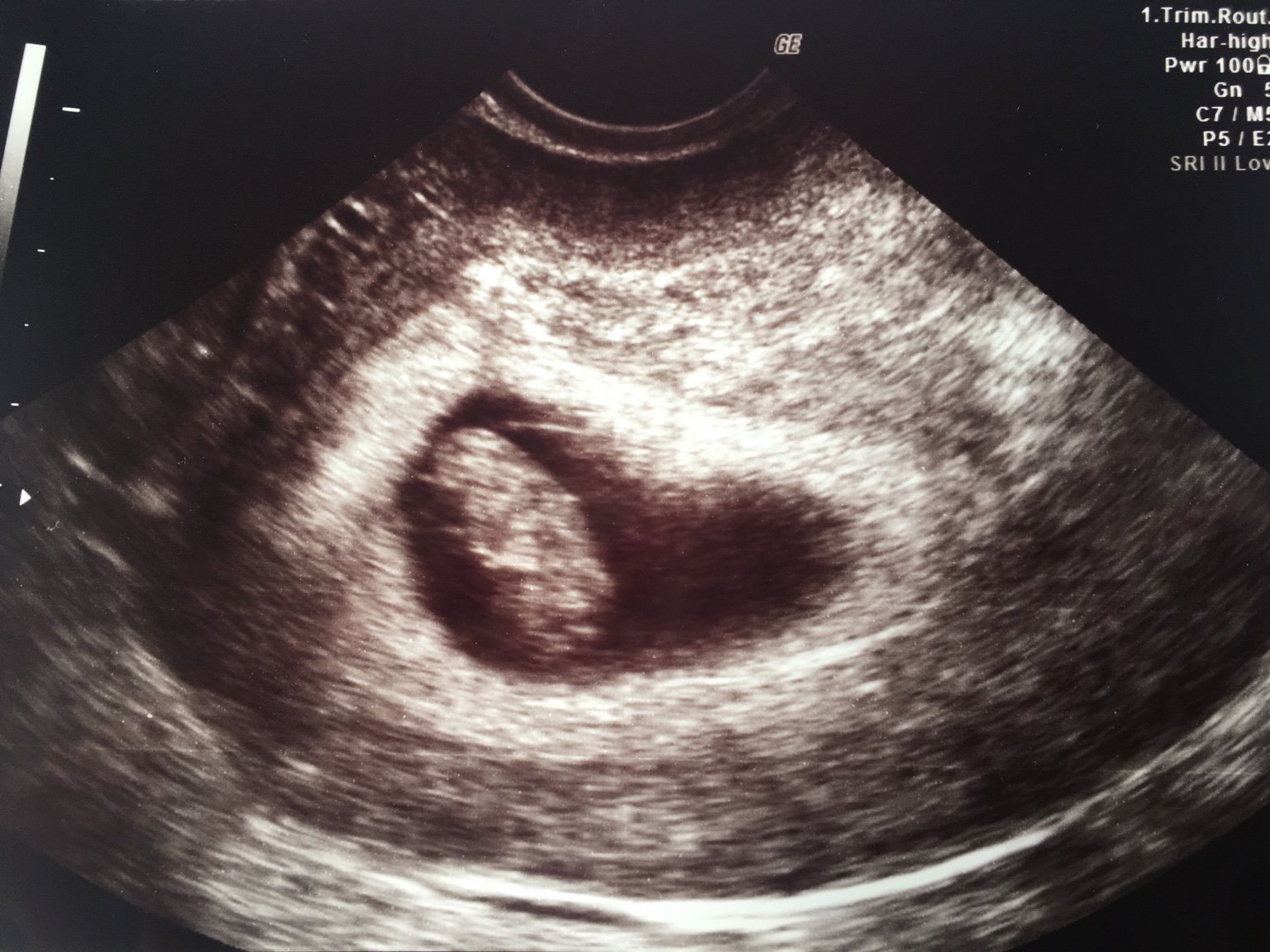 Reassurance scan 8 weeks