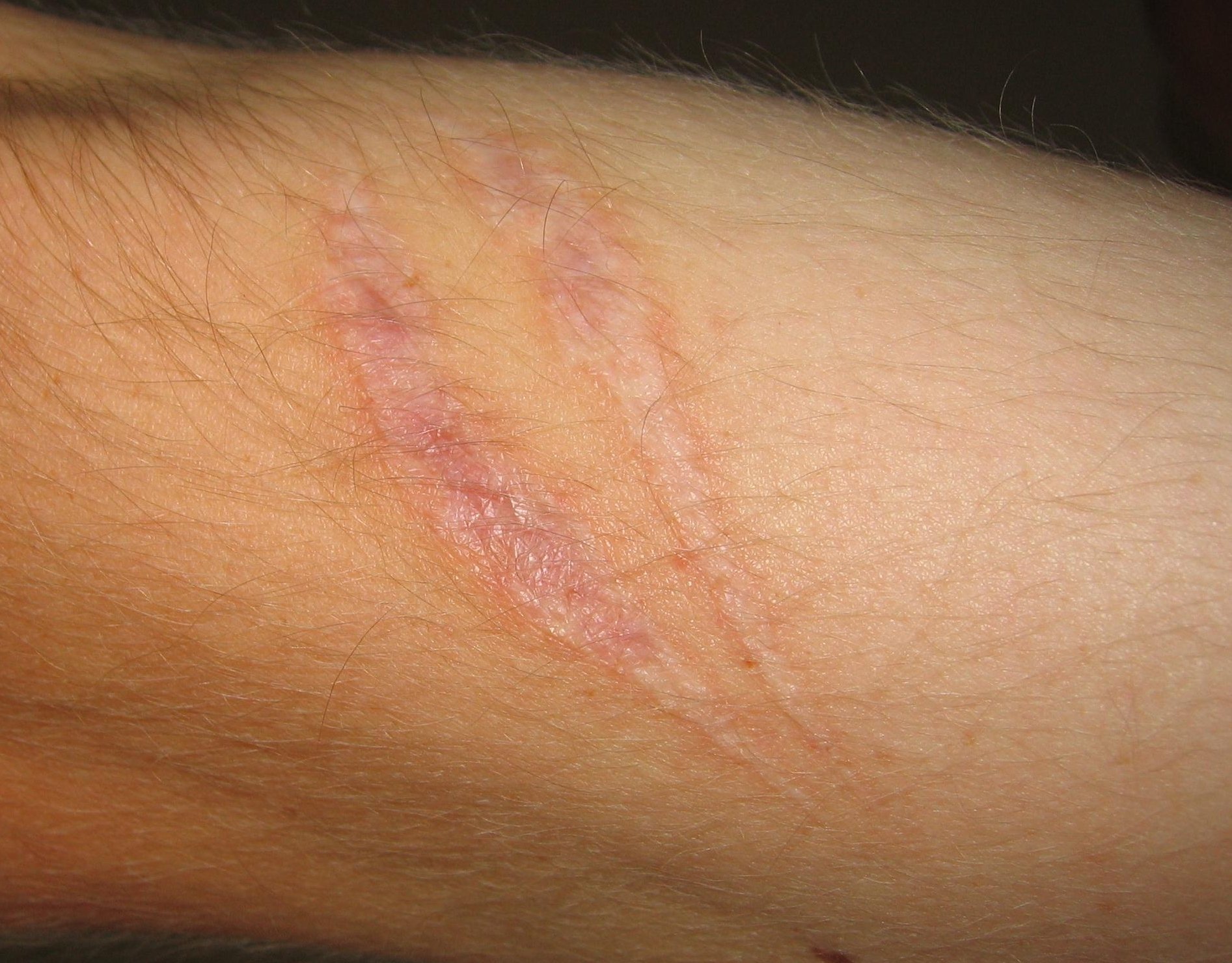 Myofascial Pain prevention Surgery Scars