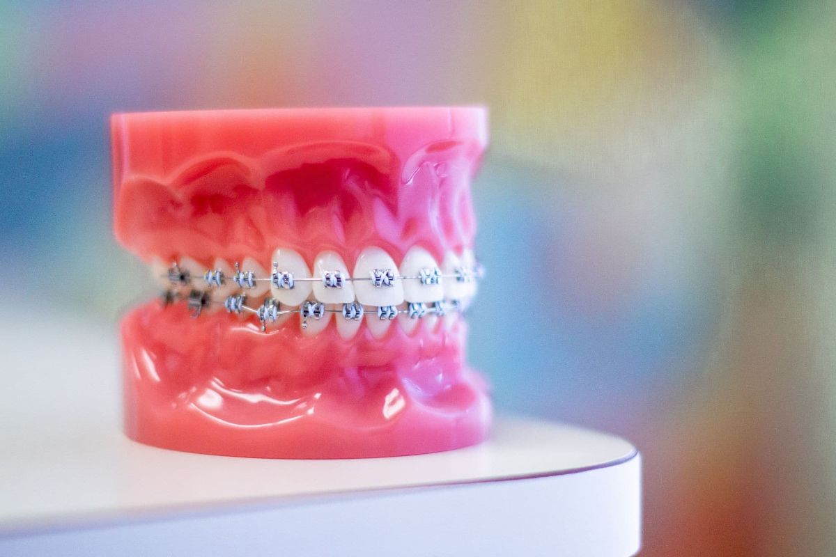 10 Myths About Braces You Need to Know Orthodontic Specialists