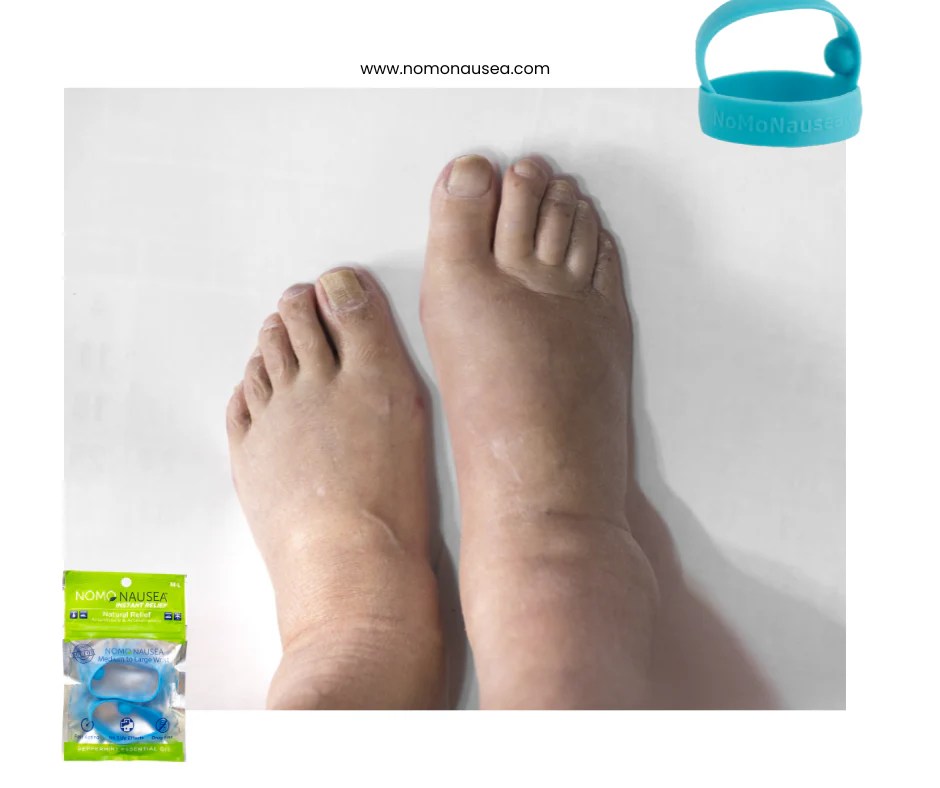 Why Do Feet Swell During Pregnancy?