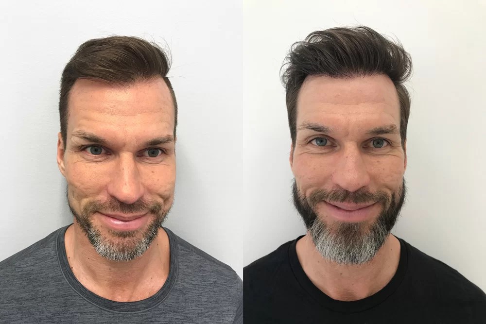 Hårtransplantation Få tillbaka håret med säker metod Nordic Hair