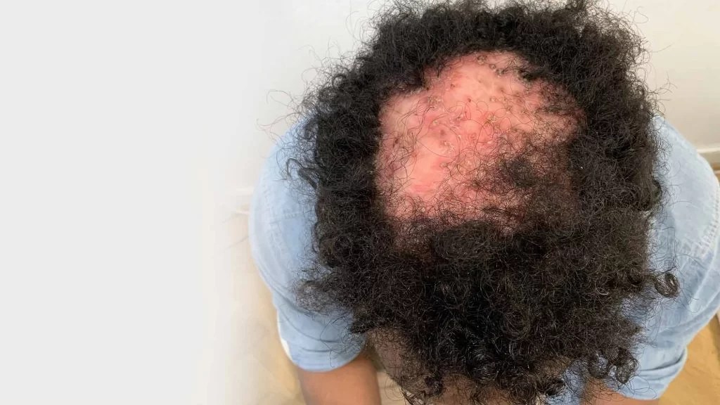 Folliculitis decalvans behandling Nordic Hair