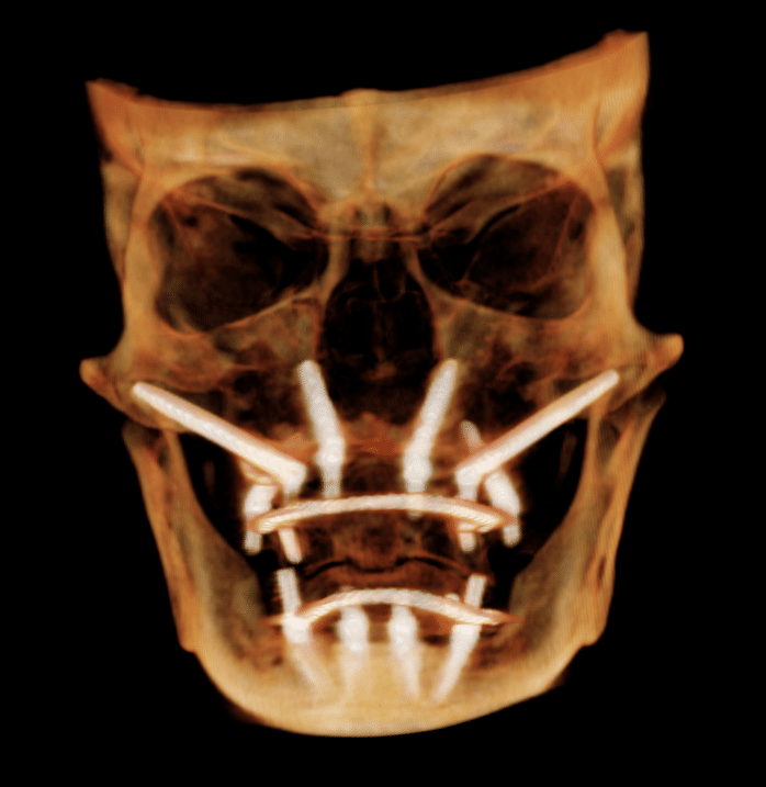 TransNasal implant as an alternative to Quad Zygomatic configuration