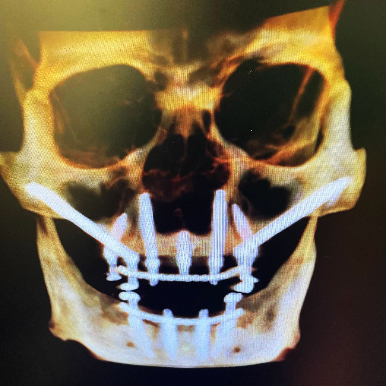 Utilization of the ZPoint with transnasal implants as an alternative
