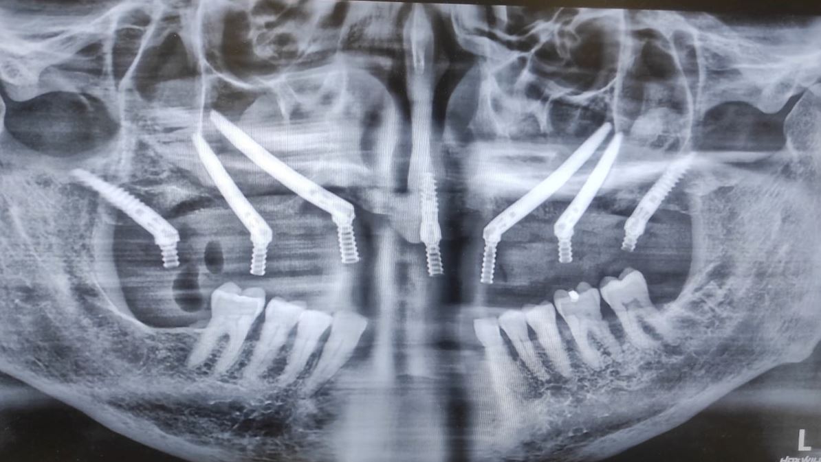 EZgoma® a Guided Full Mouth Reconstruction using Quad Zygomatic