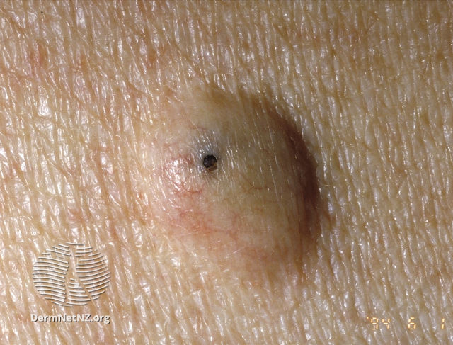 Skin Lumps and Bumps A cosmetic inconvenience or concern? Dr