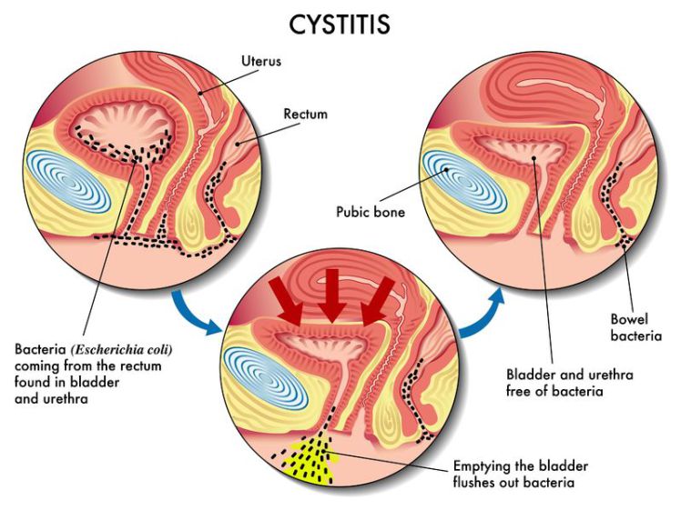 Female Recurrent Bladder Infections Northeast Urological